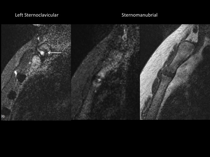 Figure 3 for case manubrium ( RID2476 )